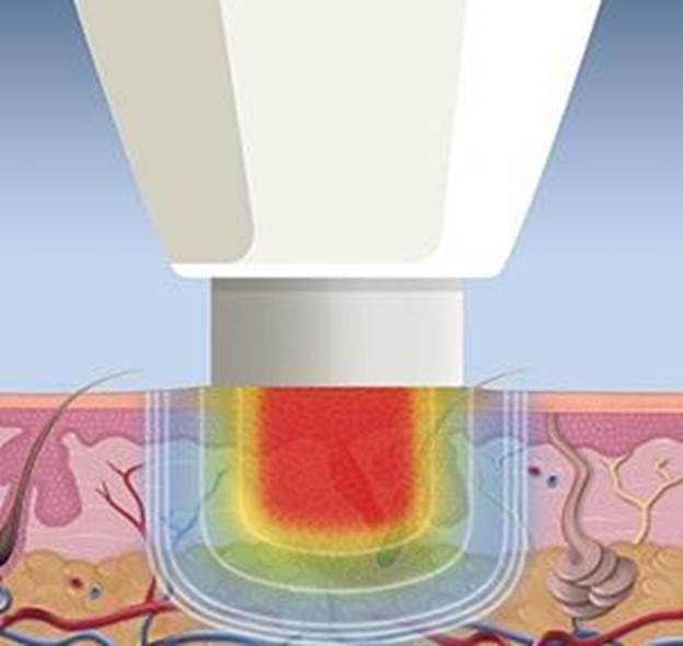 Swift4 Swift wart treatment