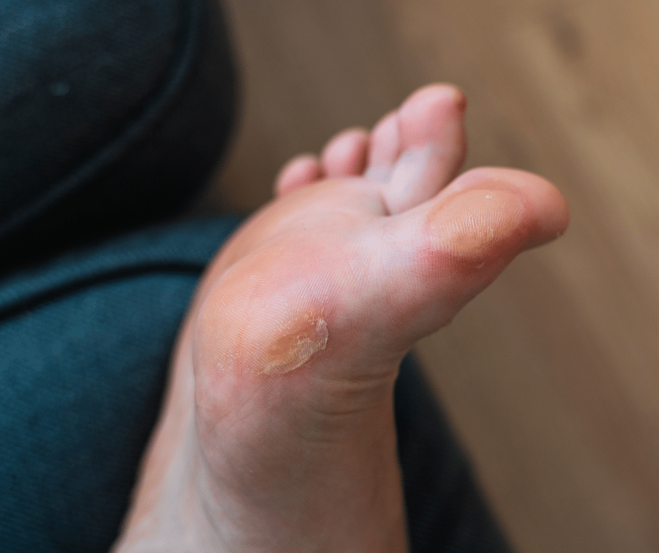 foot with blisters