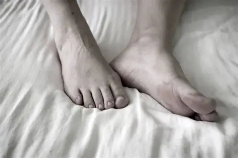 A close-up of a foot with a bunion, the bony bump that forms at the base of the big toe, the kind of bunion Dr. Hubert Lee treats conservatively at CarePlus in Bellevue