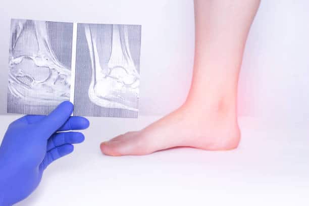 Inflamed Achilles tendon at the back of the heel shown beside ankle imaging scans, illustrating Achilles tendinitis treated at CarePlus in Bellevue.