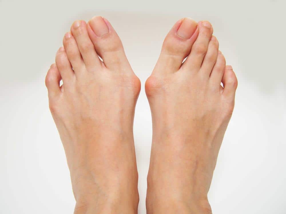 A pair of bare foot with a bunion on the right foot