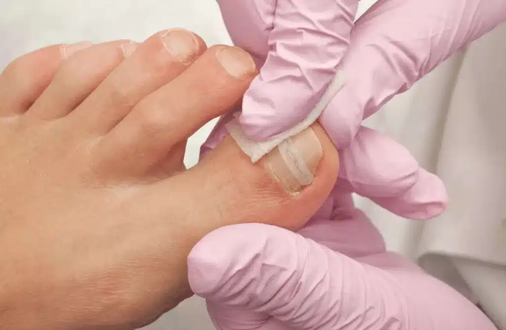 doctor wearing pink gloves is checking a patient's ingrown toenail