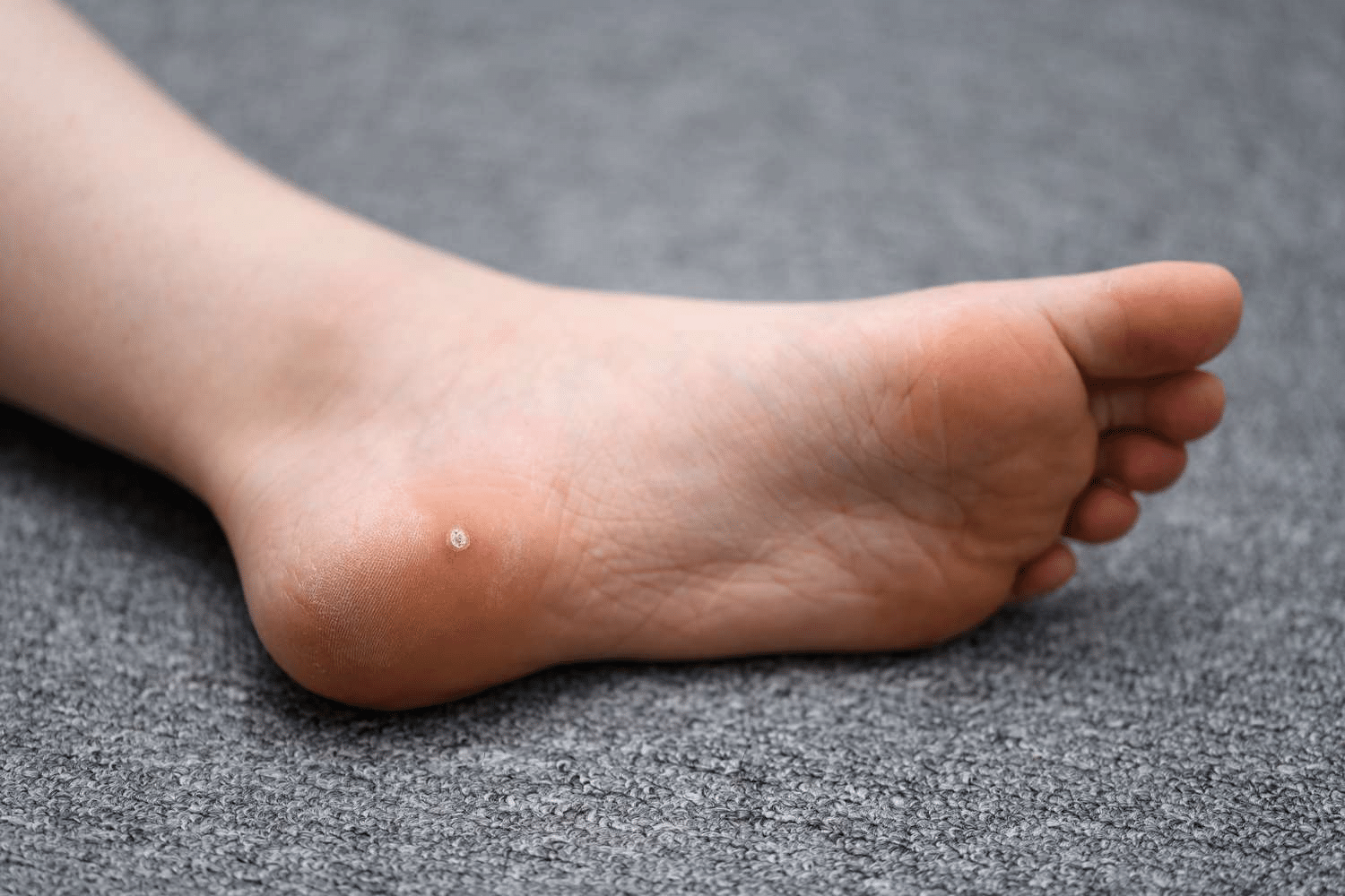 Plantar wart evaluation at CarePlus Foot and Ankle Specialists in Bellevue